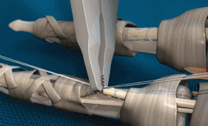 Image: The PONTiS knot-less flexor tendon repair system (Photo courtesy of Core Essence Orthopedics).
